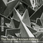 How heavy is the largest kidney stone ever discovered?